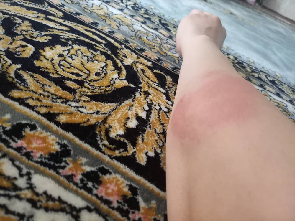 ورم و خارش دست