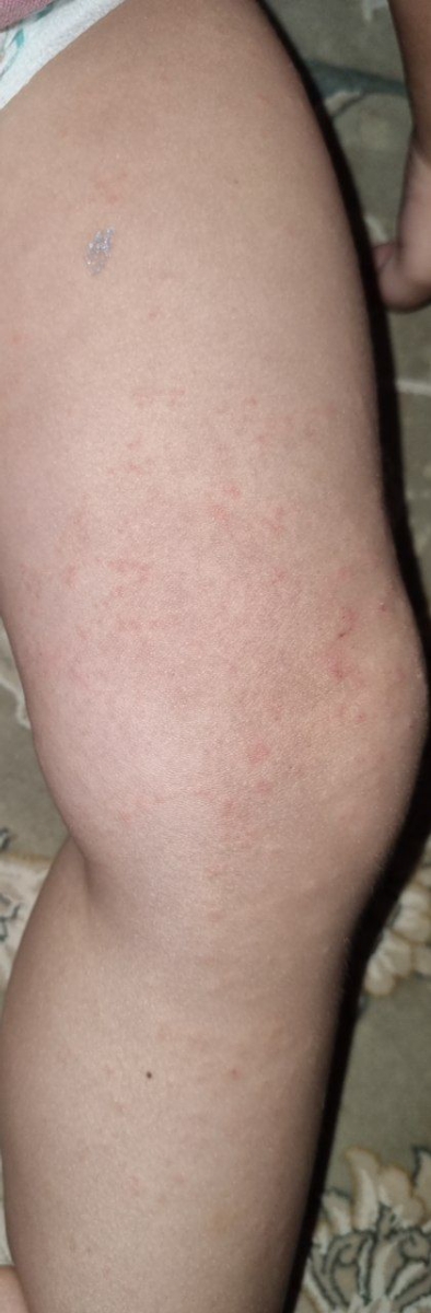 جوش پای کودک یک سالو نه ماهه خانم دکتر میشه بیاید