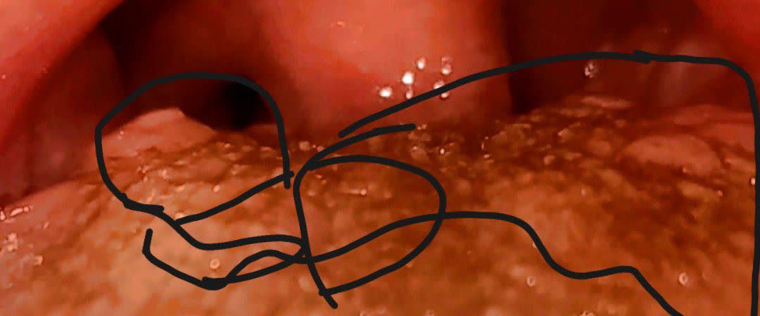 دکتر عزیز سلام چند وقت پیش در رابطه با اچ پی وی دهانی سوال پرسیدم