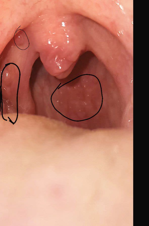 دکتر عزیز سلام چند وقت پیش در رابطه با اچ پی وی دهانی سوال پرسیدم