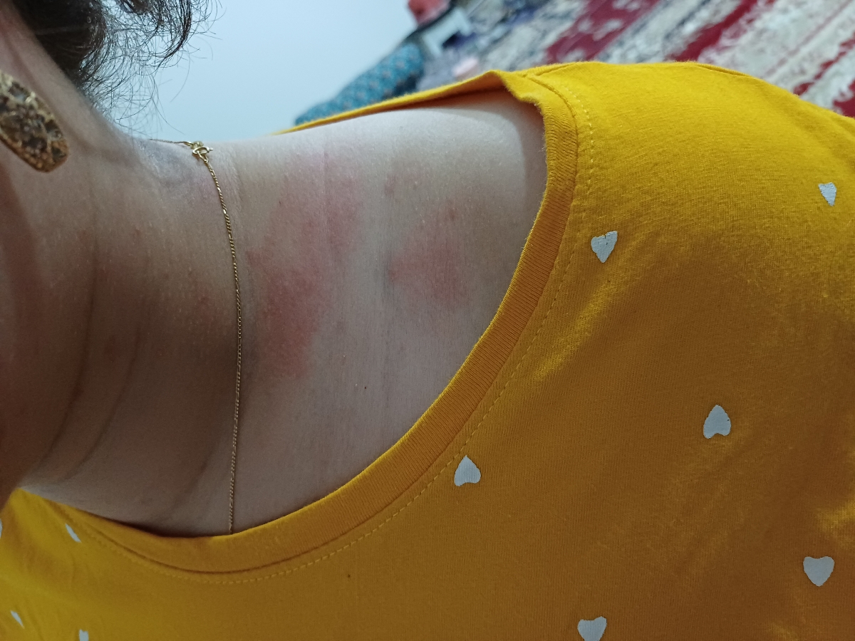 اورژانسی 🔴🔴🔴حساسیت غذایی اورژانسی 🔴🔴🔴حساسیت غذایی