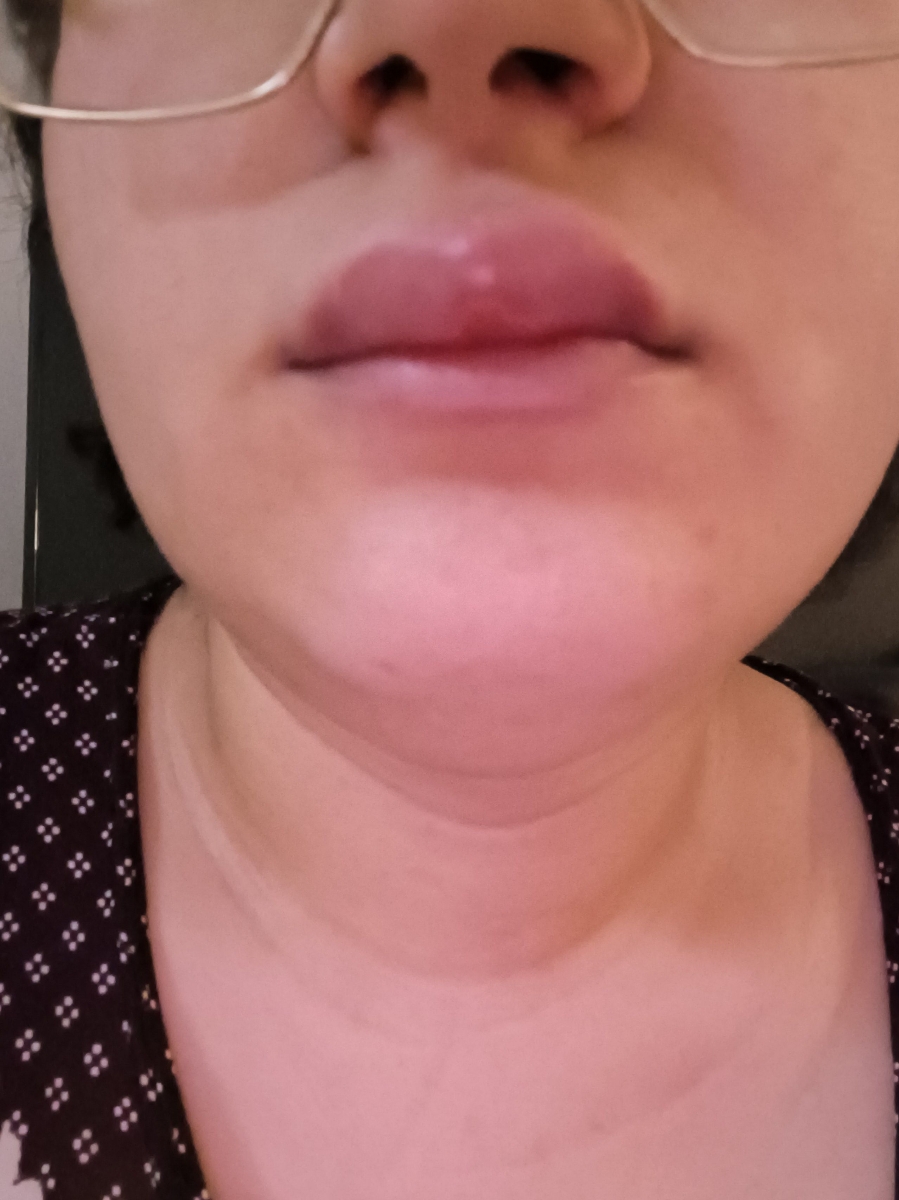 اورژانسی 🔴🔴🔴حساسیت غذایی اورژانسی 🔴🔴🔴حساسیت غذایی