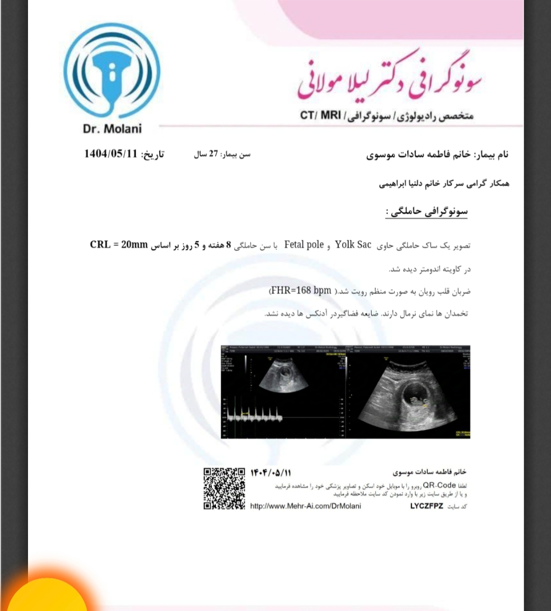 تفسیر سونو بارداری اولیه