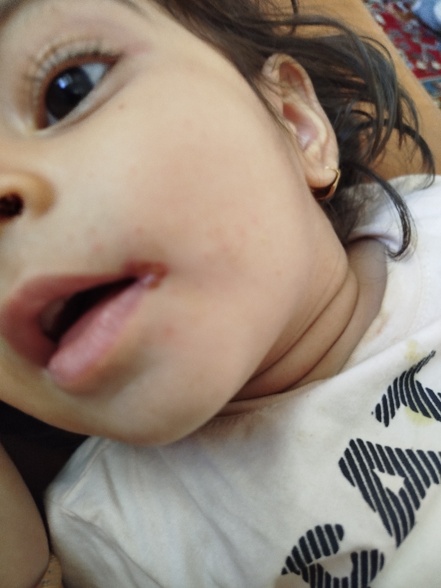 زخم‌کنار لب کودک یکساله +عکس