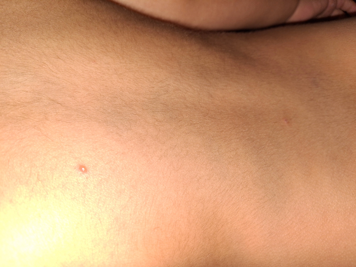 اورژانسی...این دونه هل آبله است یا نیش پشه اورژانسی...این دونه هل آبله است یا نیش پشه