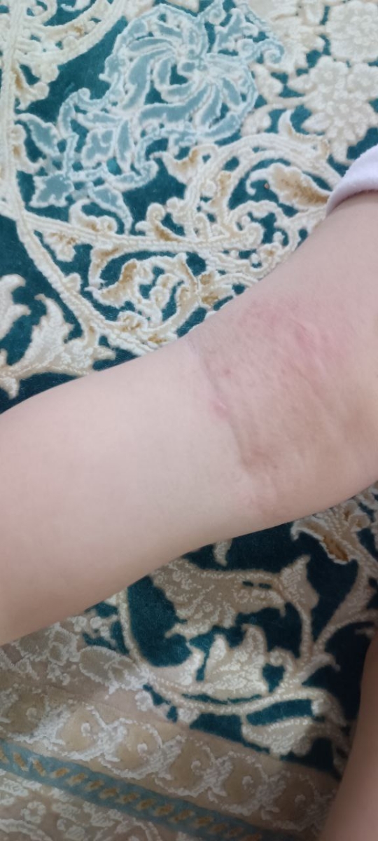 خشکی و خارش پشت زانو پسرم دور گردنش هم خشک شده