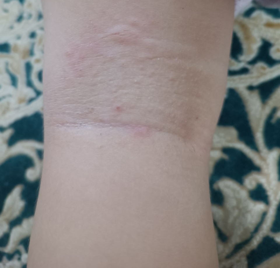 خشکی و خارش پشت زانو پسرم دور گردنش هم خشک شده