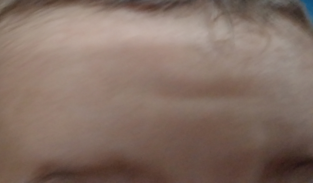 ضربه ب پیشونی کودک