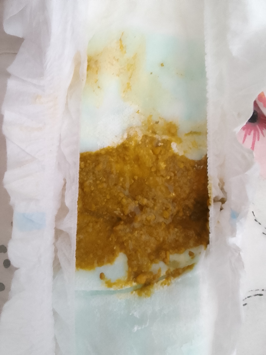 مدفوع آبکی و شل نوزاد ۵۲ روزه + عکس مدفوع آبکی و شل نوزاد ۵۲ روزه + عکس