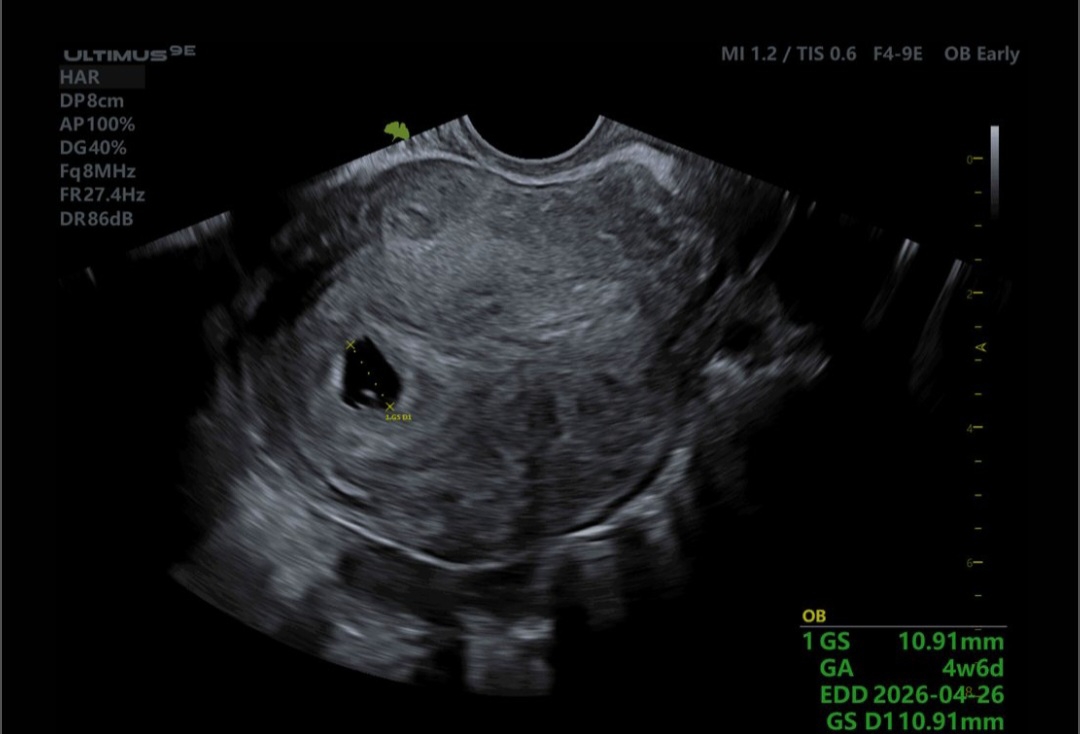 سقط با قرص سایتوتک سقط با قرص سایتوتک