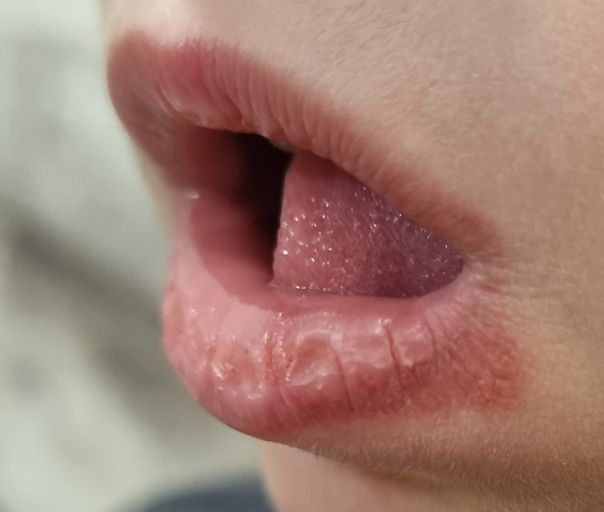 قرمزی کنار لب کودک