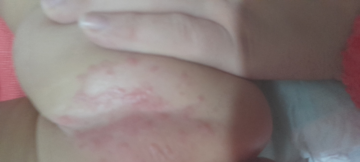 دونه دونه و قرمز بودن بغل پا دختر یک ساله دونه دونه و قرمز بودن بغل پا دختر یک ساله