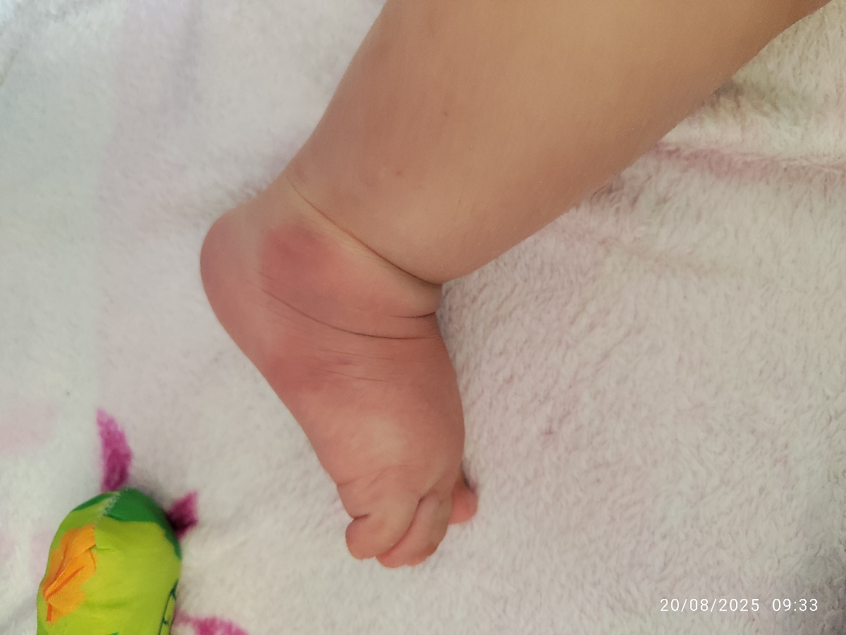 زنبور زده پسرمو کبود شده 🥺 زنبور زده پسرمو کبود شده 🥺