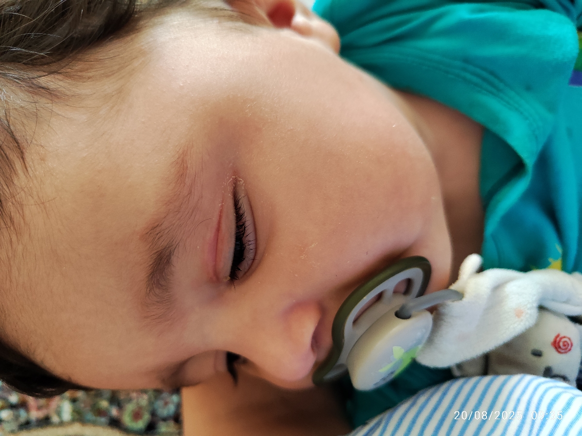 زنبور زده پسرمو کبود شده 🥺 زنبور زده پسرمو کبود شده 🥺