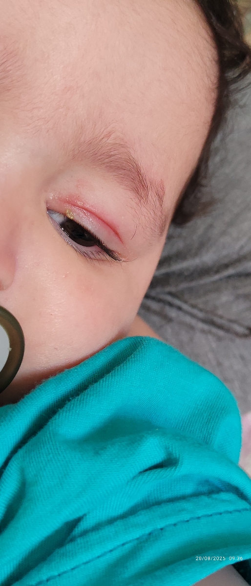 زنبور زده پسرمو کبود شده 🥺 زنبور زده پسرمو کبود شده 🥺