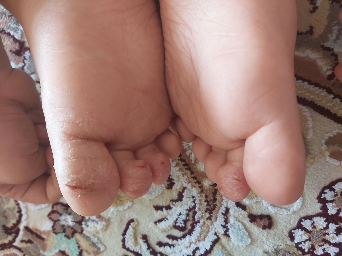 ترک و زخم پای پسر ۶ ساله همراه با عکس ترک و زخم پای پسر ۶ ساله همراه با عکس