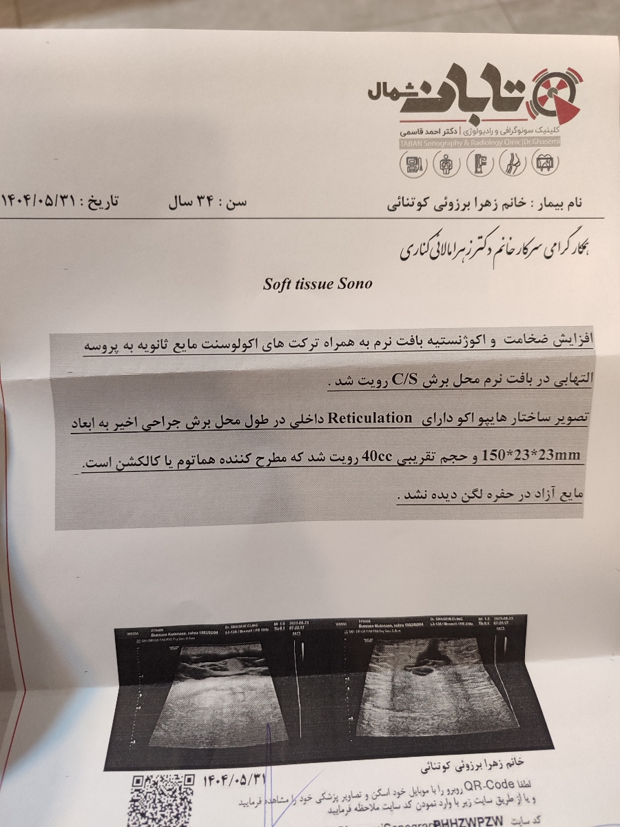 تجمع مایع( هماتوم یا عفونت )در محل بخیه سزارین تجمع مایع( هماتوم یا عفونت )در محل بخیه سزارین