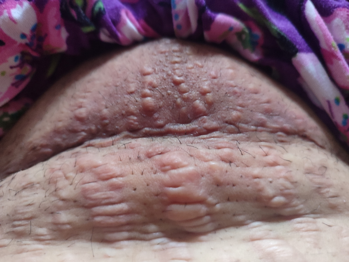 تجمع مایع( هماتوم یا عفونت )در محل بخیه سزارین تجمع مایع( هماتوم یا عفونت )در محل بخیه سزارین