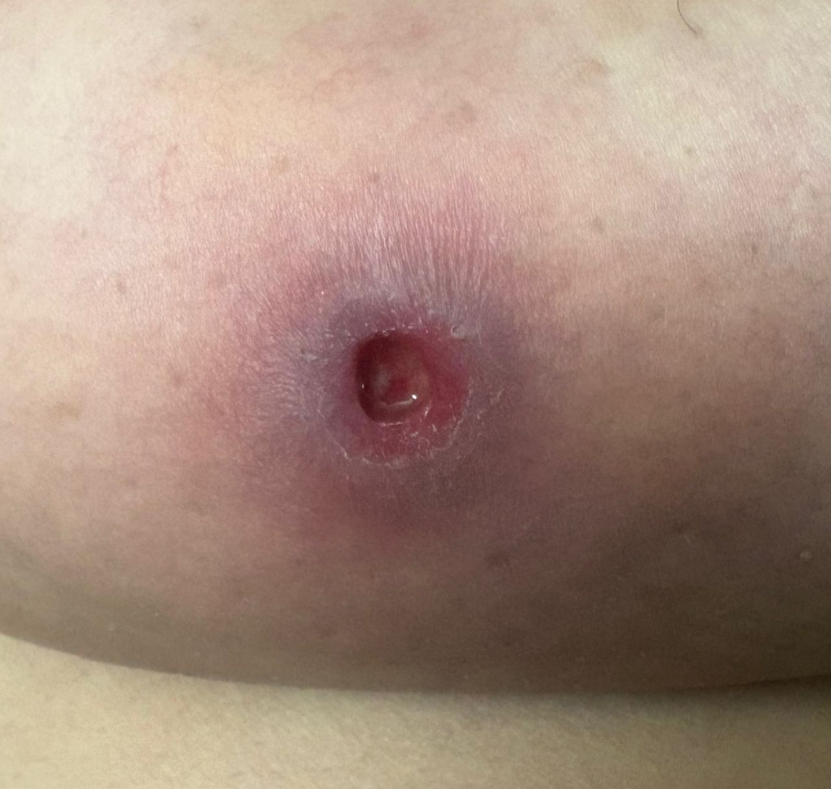 کورک زیر سینه خانوم ۴۹ ساله کورک زیر سینه خانوم ۴۹ ساله