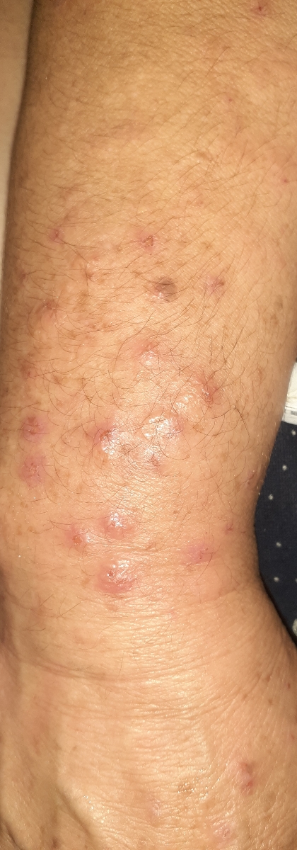 حساسیت پوستی به برگ و شیره درخت انجیر حساسیت پوستی به برگ و شیره درخت انجیر