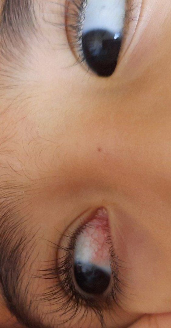 قرمزی چشم پسر سه ساله قرمزی چشم پسر سه ساله