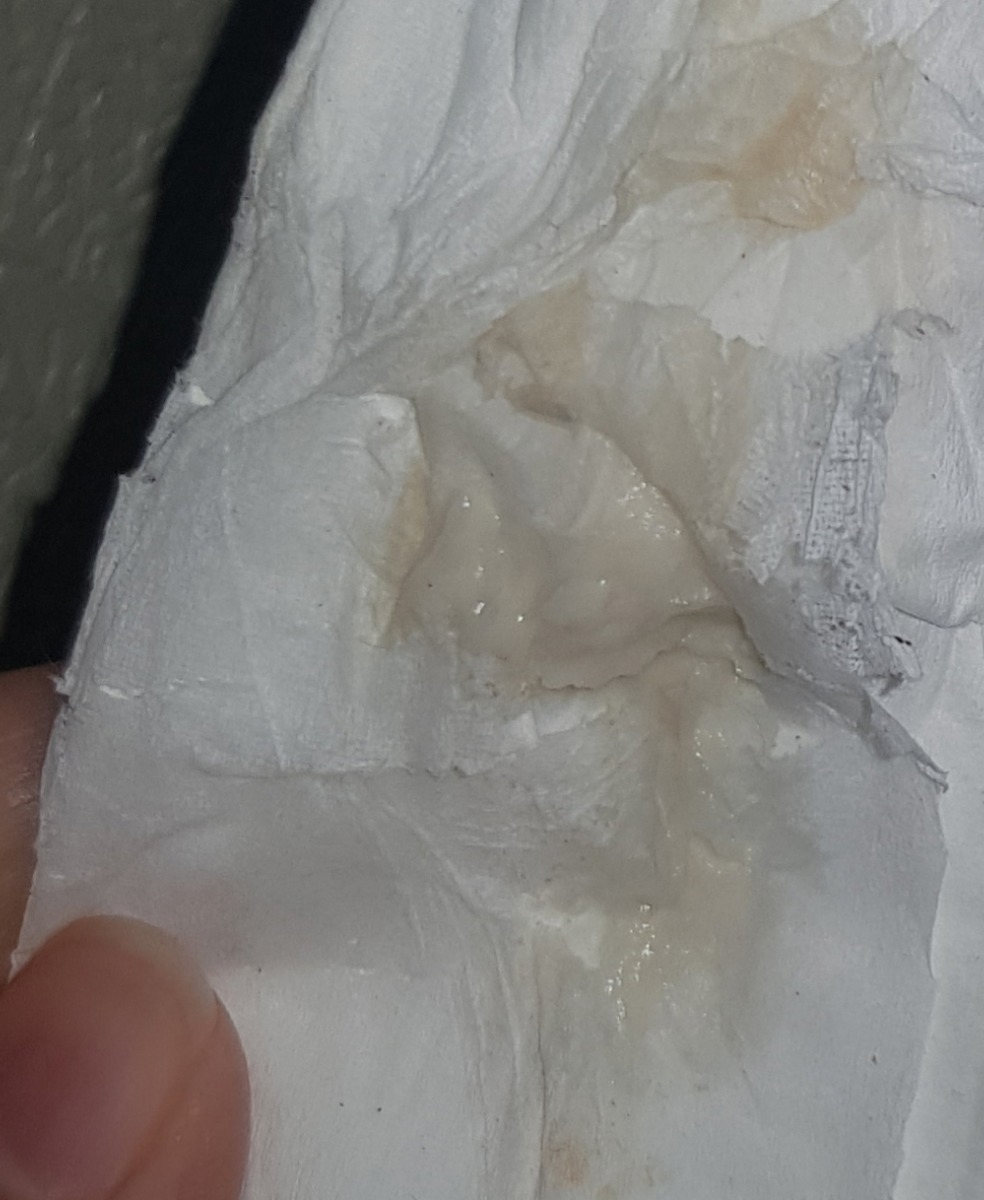 عفونت واژن اوایل بارداری