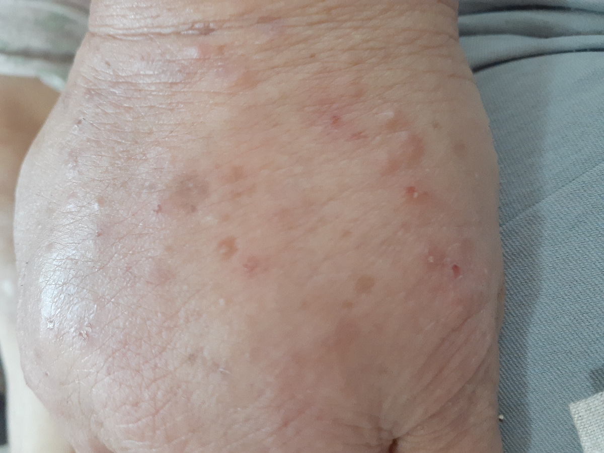 حساسیت پوستی به برگ و شیره درخت انجیر