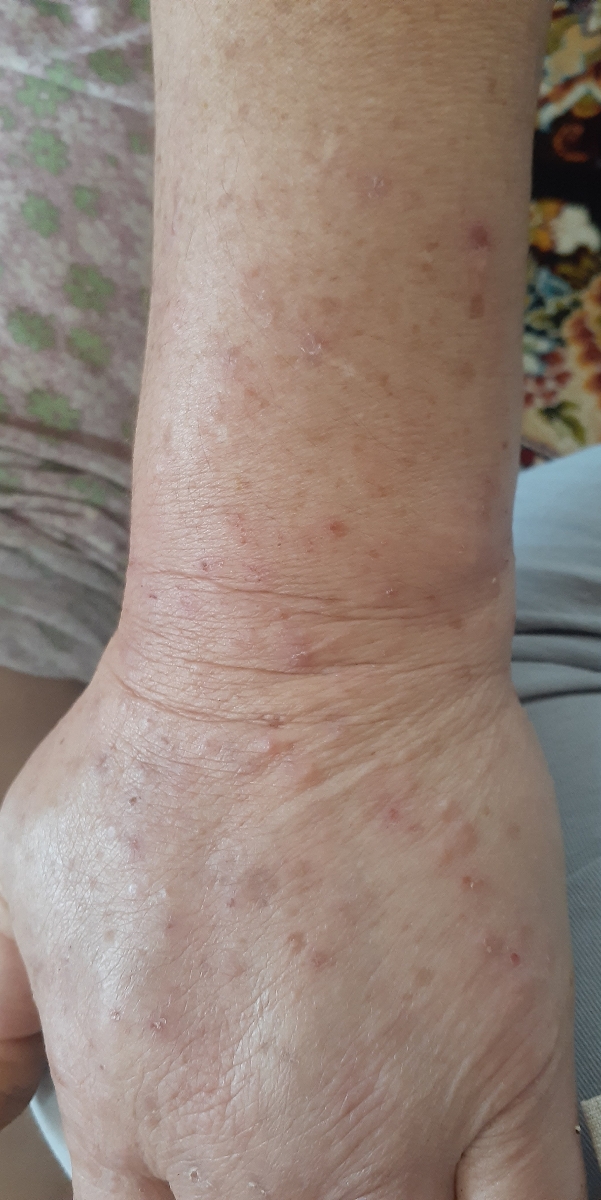 حساسیت پوستی به برگ و شیره درخت انجیر