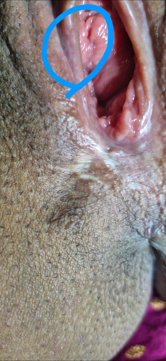 اینجا یه دونه زده که نمیدونم چرا سر باز نمیکنه زیر پوسته