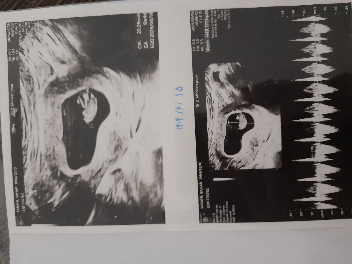 لکه بینی ترشحات قهوه ای صورتی