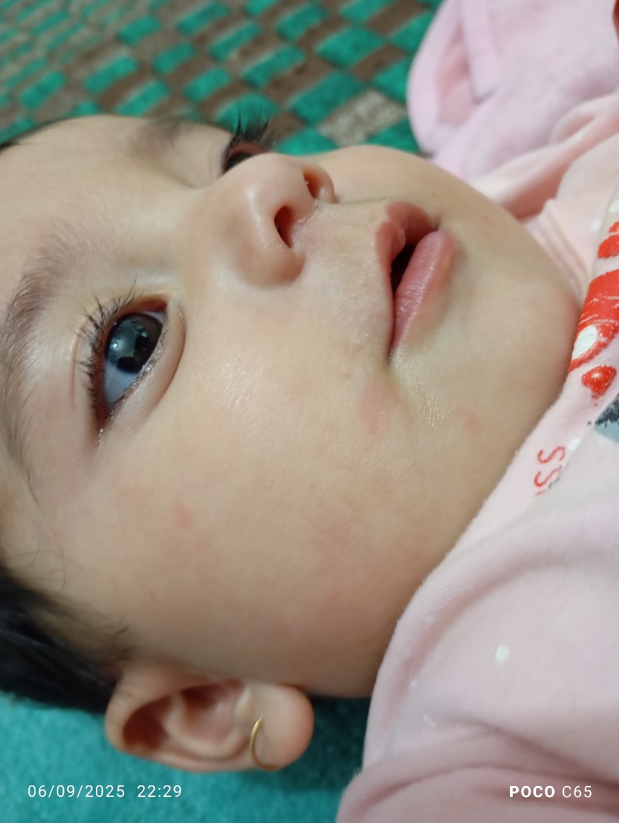 دلیل کهیر زدن کنار لب و پای کودک
