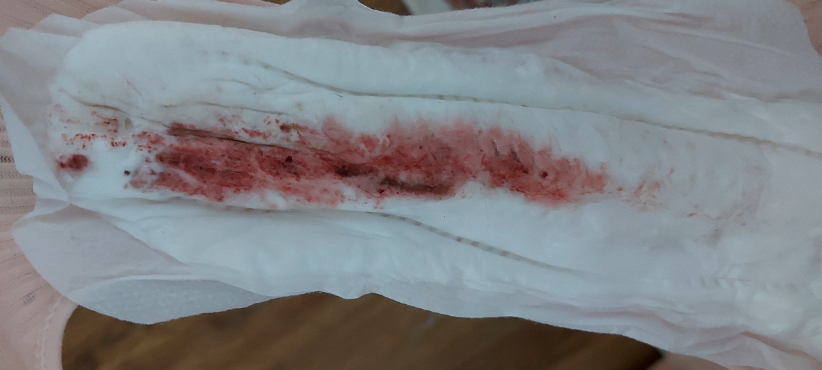 هماتوم و خونریزی