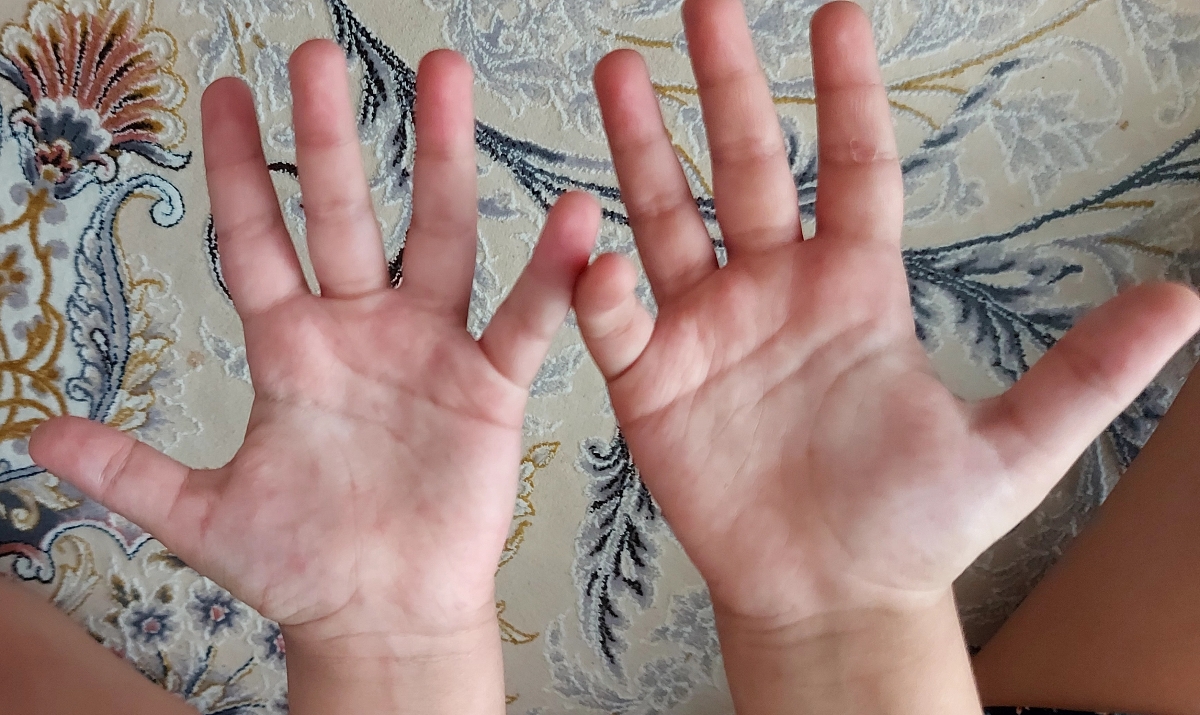لکه و دانه قرمز روی کف دست