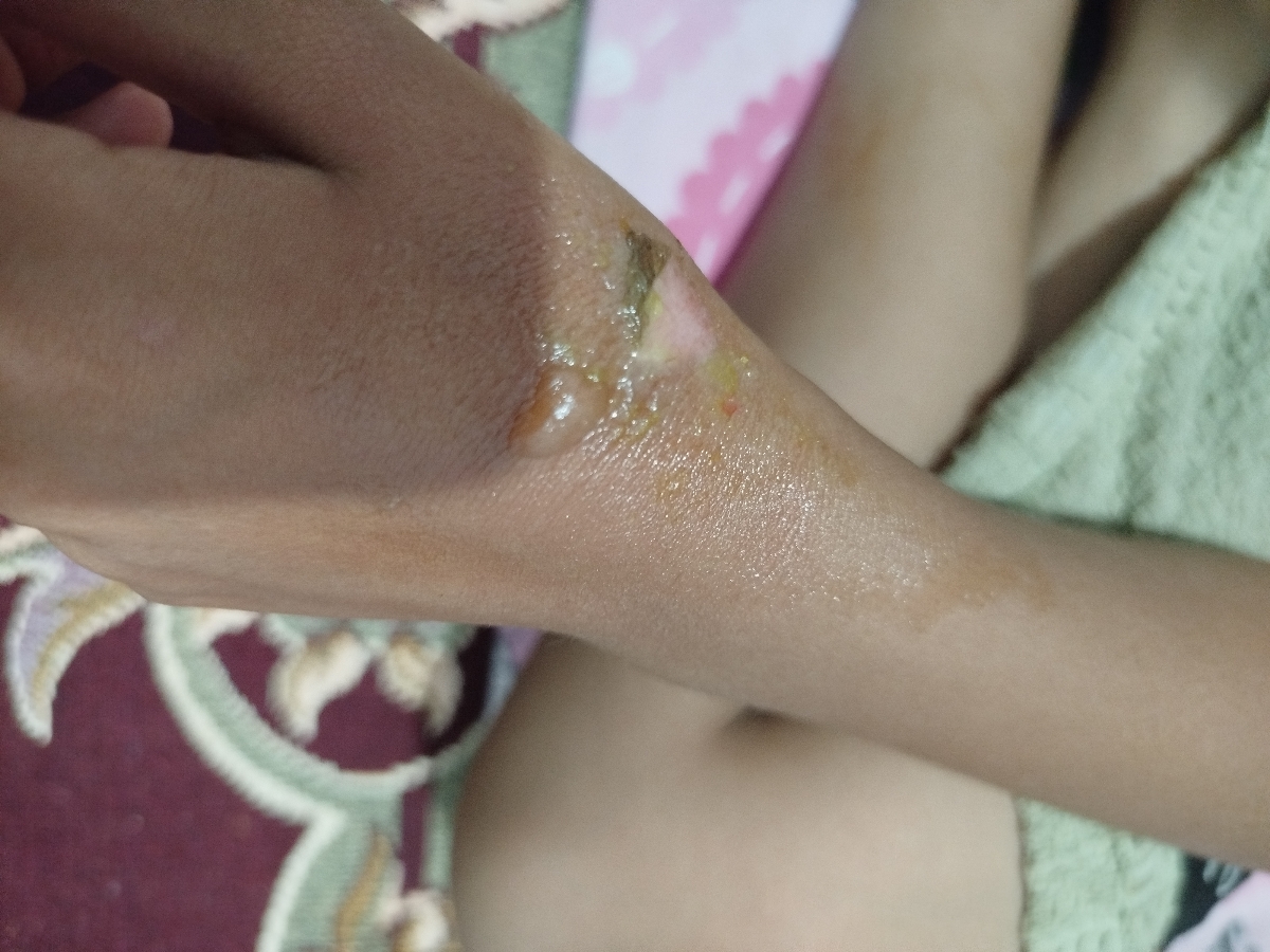 سوختگی دست بچه 8ساله