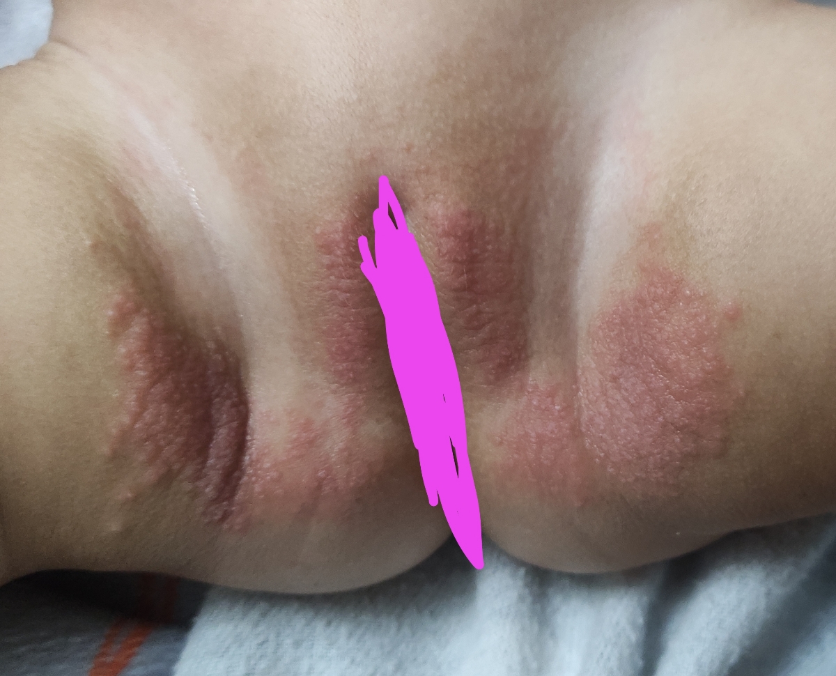 سوختگی و دانه زدن پای نوزاد