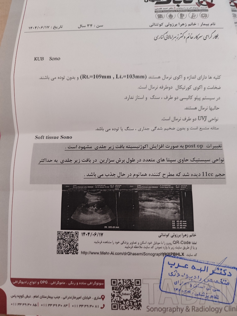 هماتوم بعد عمل سزارین هماتوم بعد عمل سزارین