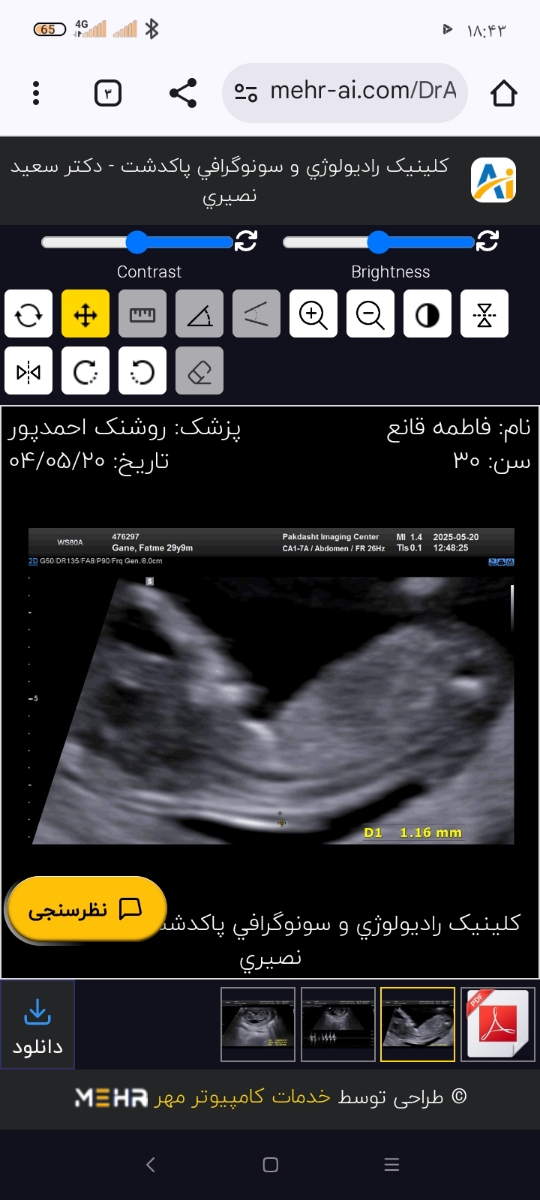 تشخیص سونوگرافی جنسیت دختر یا پسر