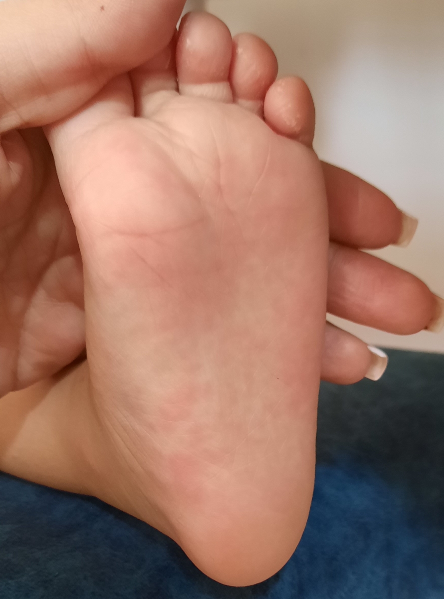 کف پاهاش به این صورت قرمزه