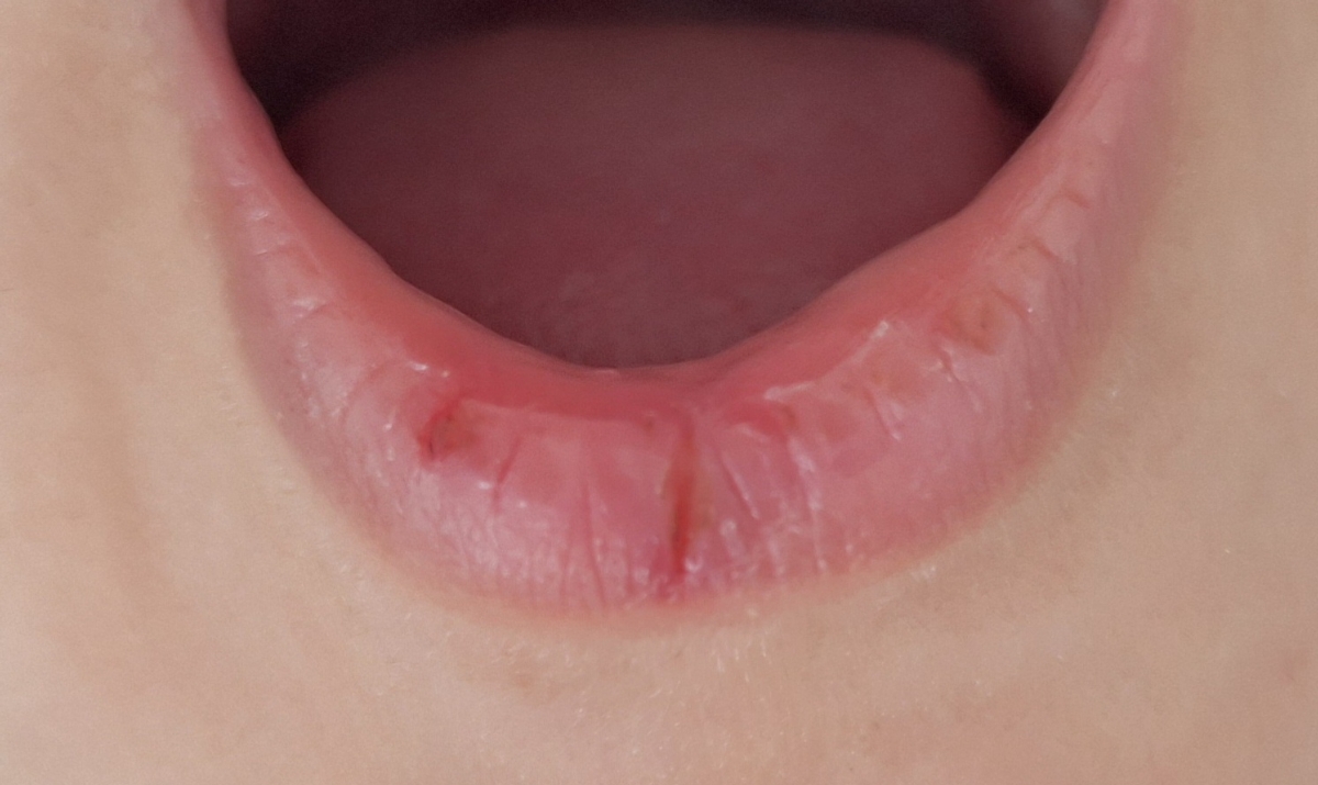 ترک خوردن لب کودک