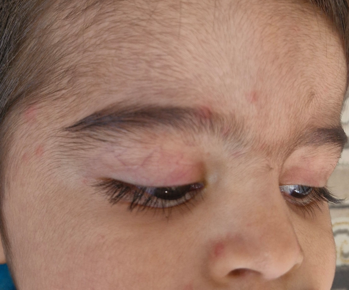 دونه روی بدن کودک ۱سالو نیمه