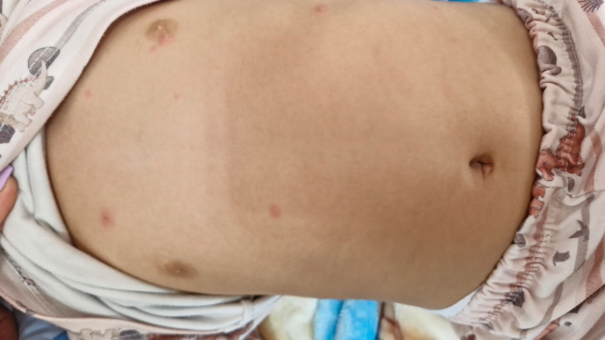 دونه روی بدن کودک ۱سالو نیمه