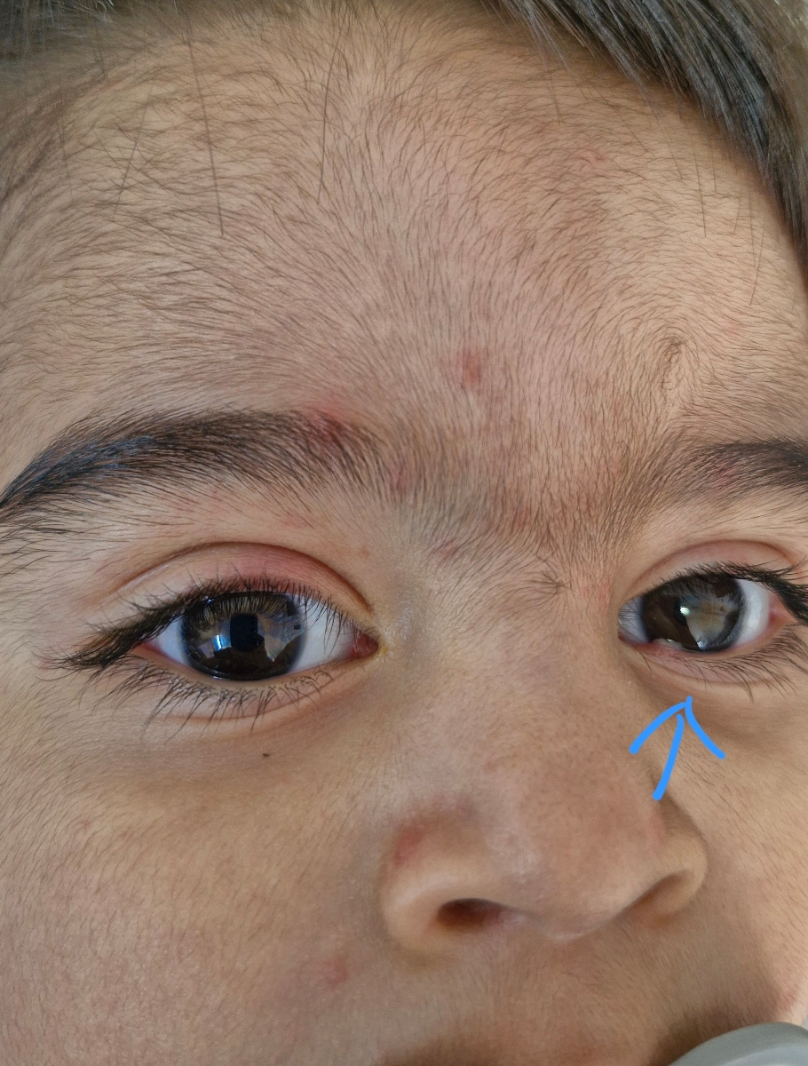 داخل این چشمش هم زده داخل این چشمش هم زده