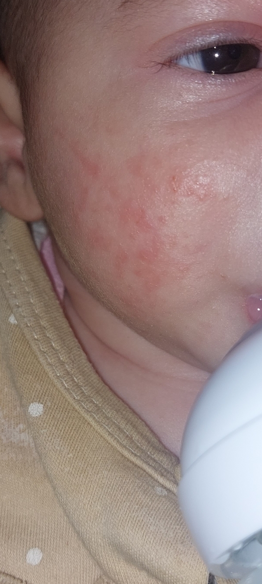 صورتش هم اینجوری شده از دیروز کرم ثمین میزنم با کالاندولا ولی اثر نمیکنه میترسم بمونه صورتش هم اینجوری شده از دیروز کرم ثمین میزنم با کالاندولا ولی اثر نمیکنه میترسم بمونه