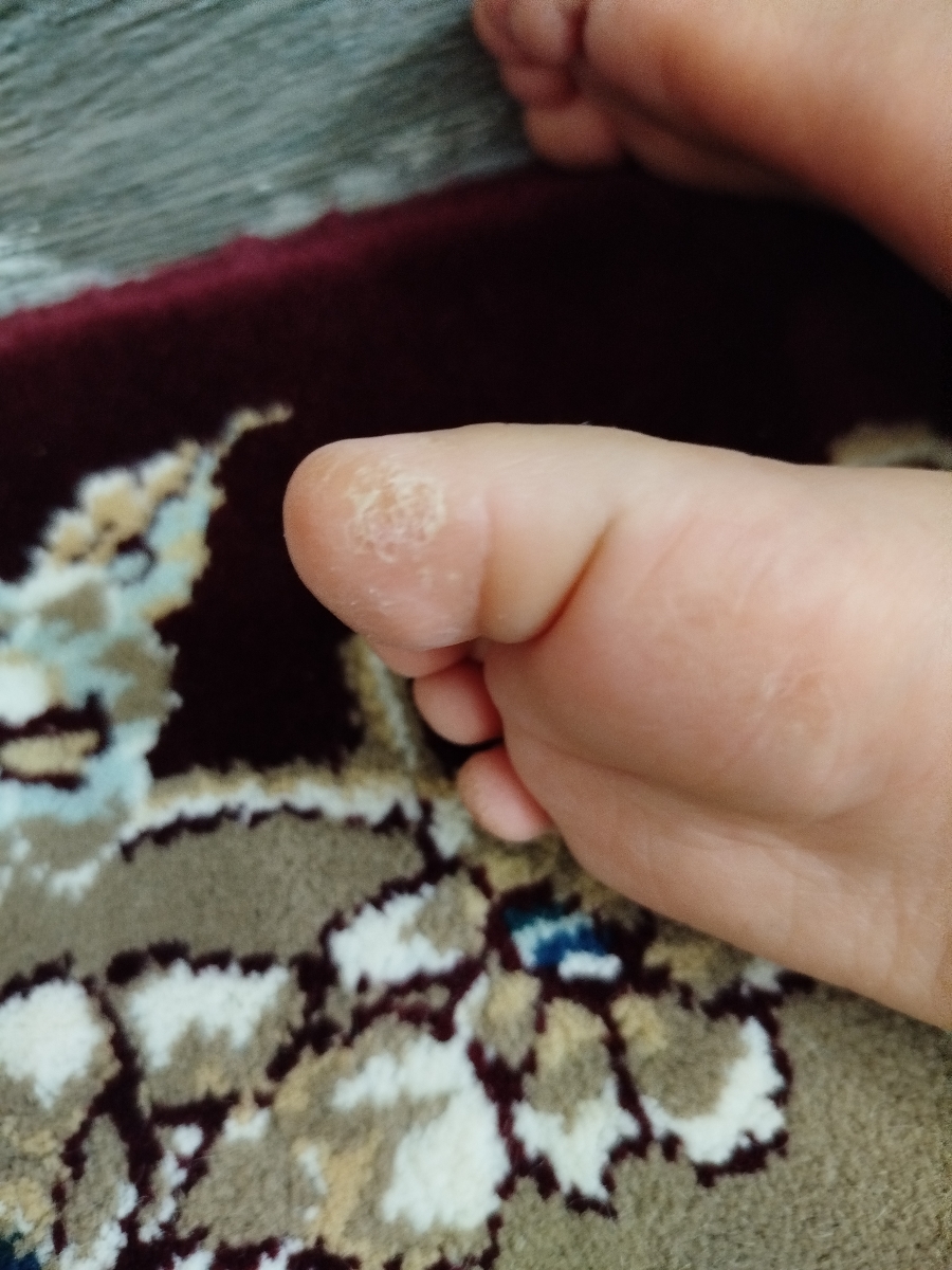خشکی و پوسته شدن انگشت پای کودک ۱۸ماهه