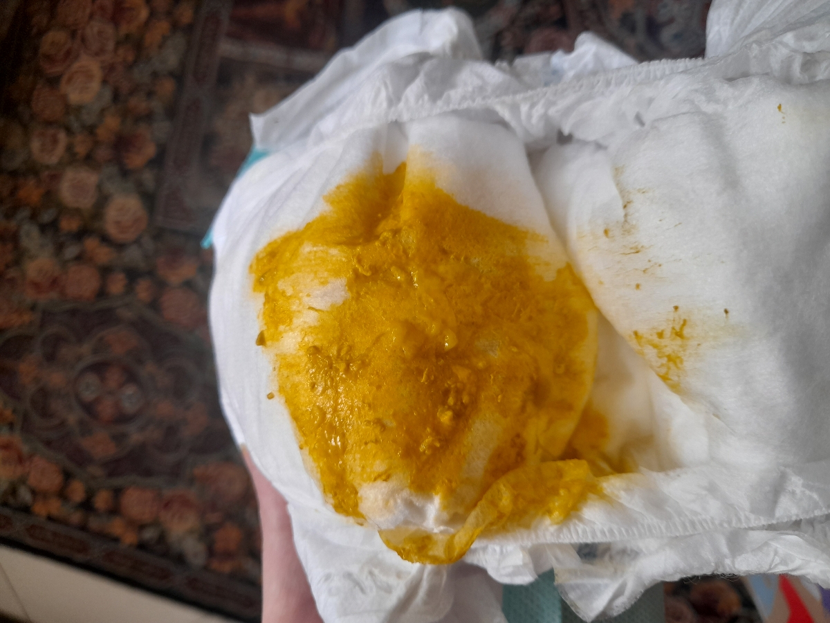 با عرض معذرت از دوستان آیا این مدفوع نوزاد طبیعیه؟ با عرض معذرت از دوستان آیا این مدفوع نوزاد طبیعیه؟