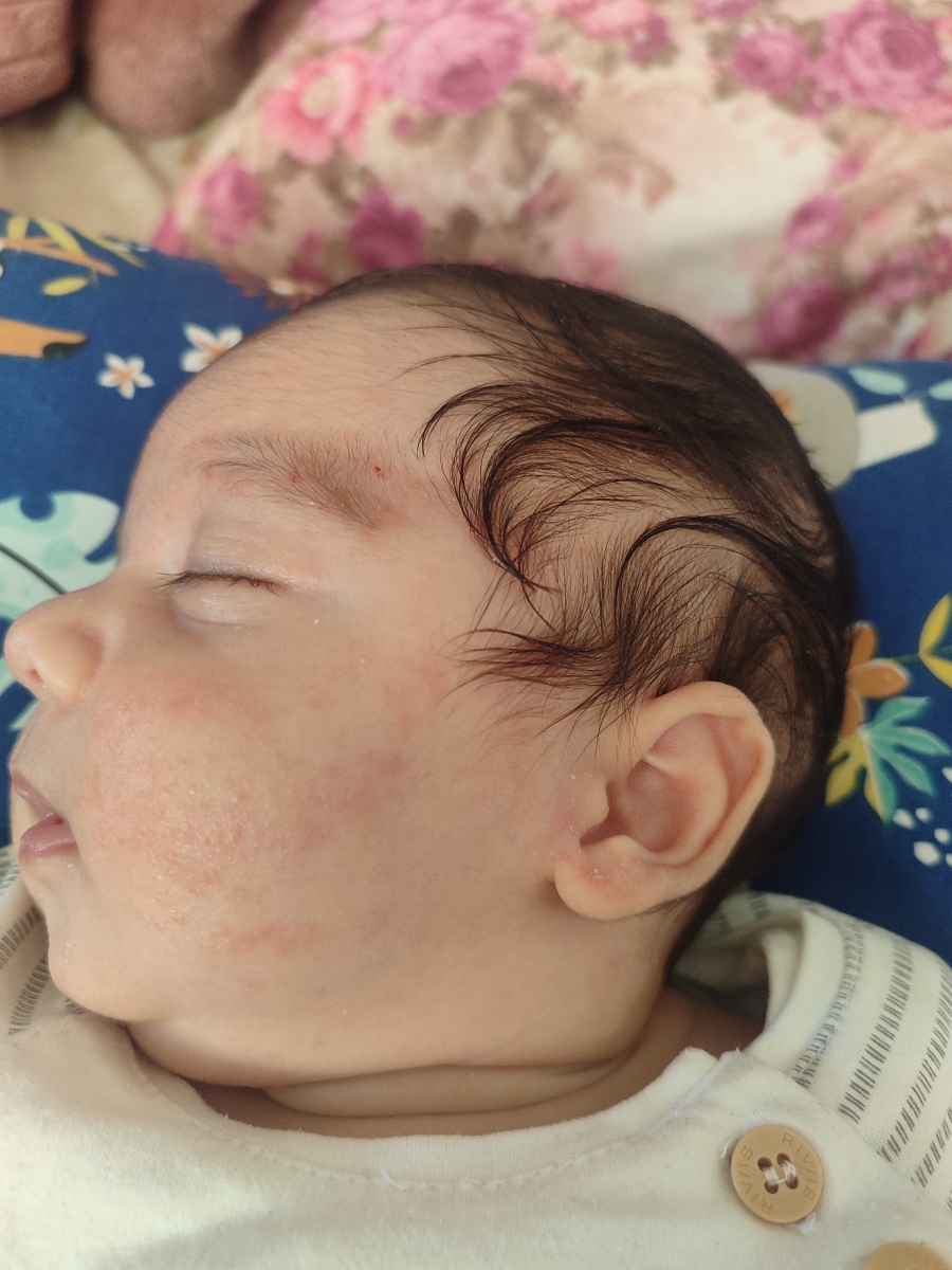 خلط پشت حلق نوزاد