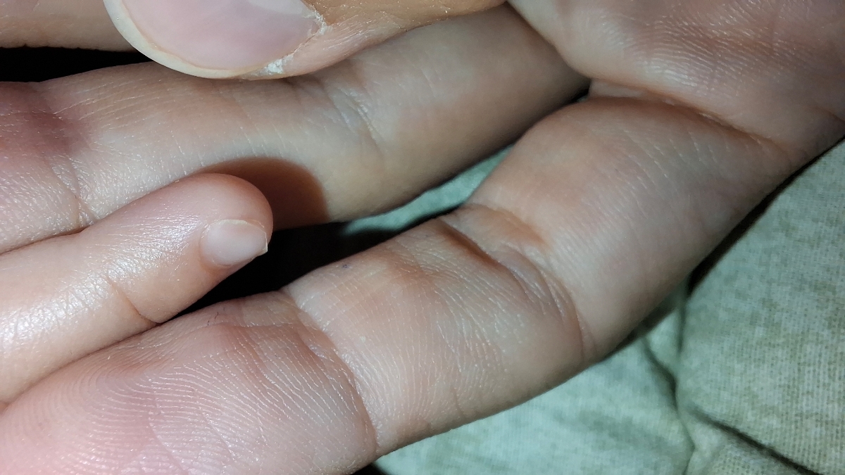 ناخن قاشقی کودک ده ماهه