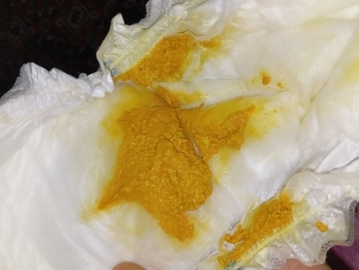 بی قراری و دون دون شدن پای نوزاد