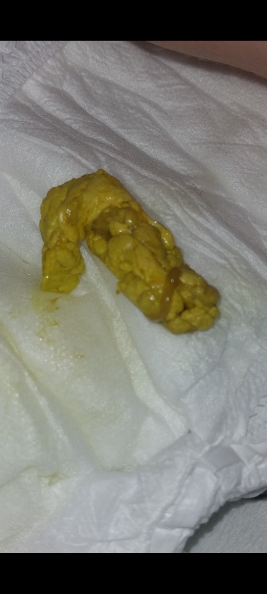 مدفوع خلطی نوزاد دو ماهه مدفوع خلطی نوزاد دو ماهه