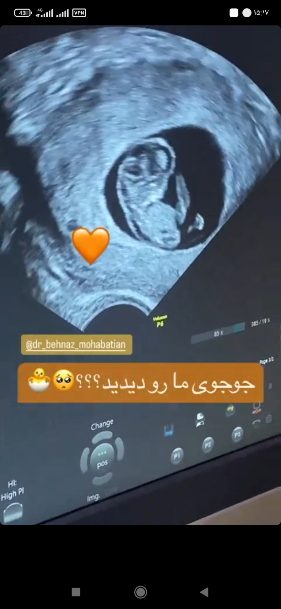 این عکس سونوی همون روزمه دکتر منتظری استوری کرد 